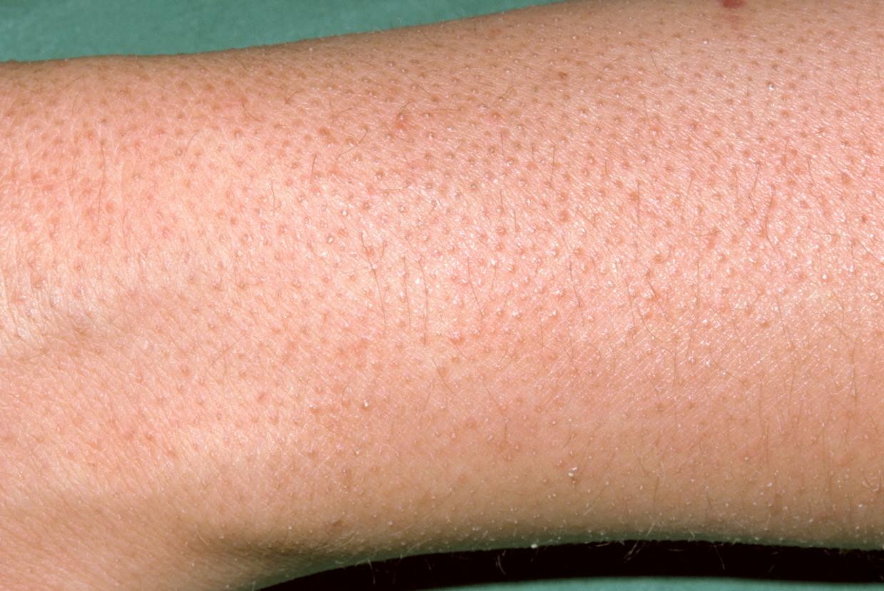 Skin rashes in children nidirect